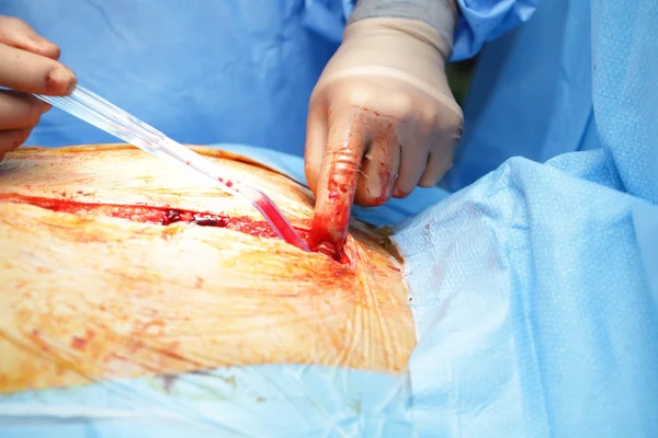 Kirurgens hænder i blodet ved såret - Stock-foto