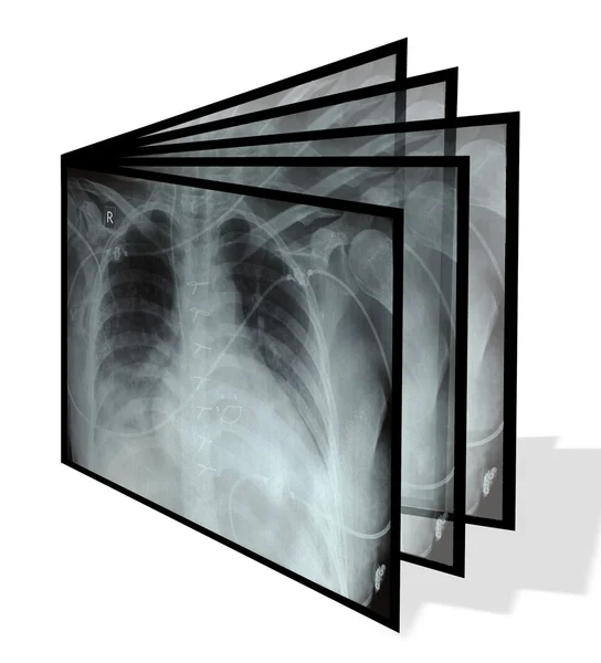 Collage from chest X-rays. Isolated on white — Stock Photo, Image