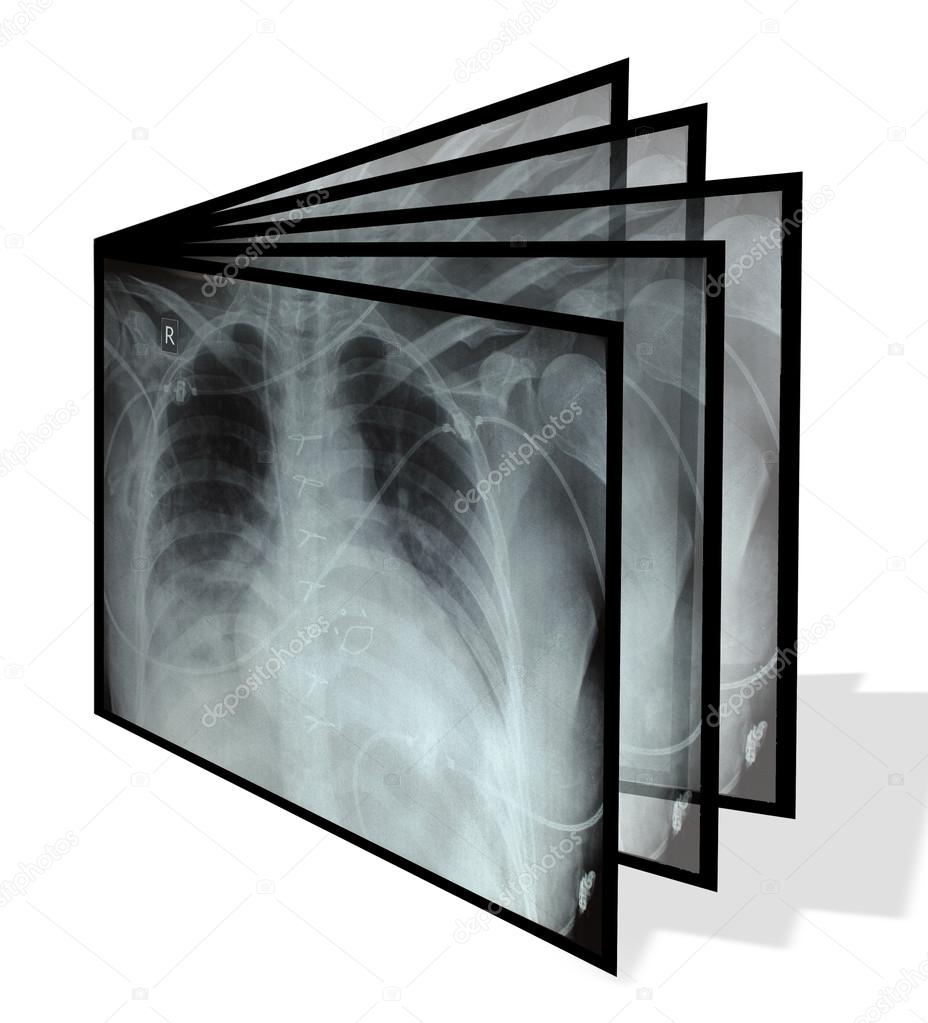 Collage from chest X-rays. Isolated on white 