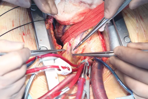 Cirurgia cardíaca. Cirurgia cardíaca aberta. Cirurgião de revascularização do miocárdio — Fotografia de Stock