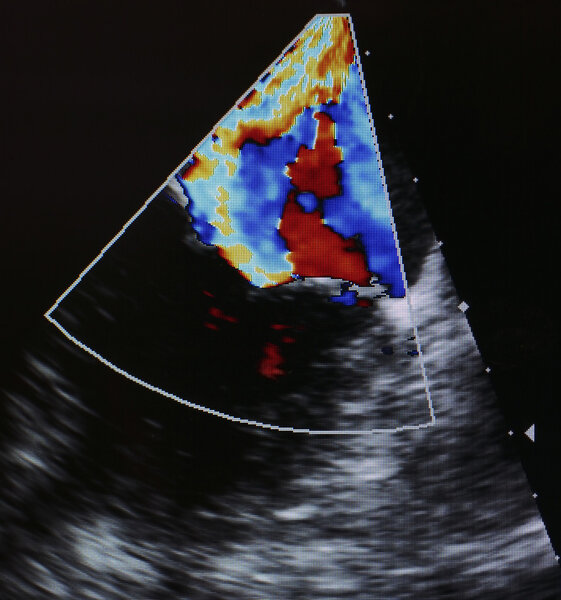 Деталь цветного доппрера. Ультразвуковая технология
 