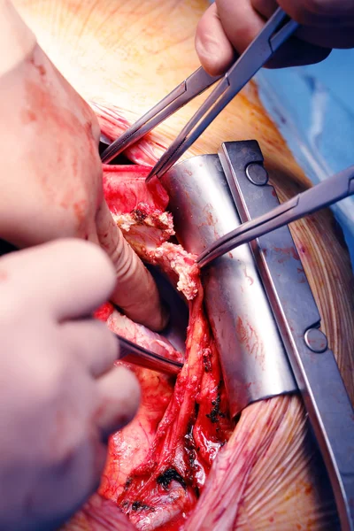 Cardiac surgery at "armored heart" — Stock Photo, Image