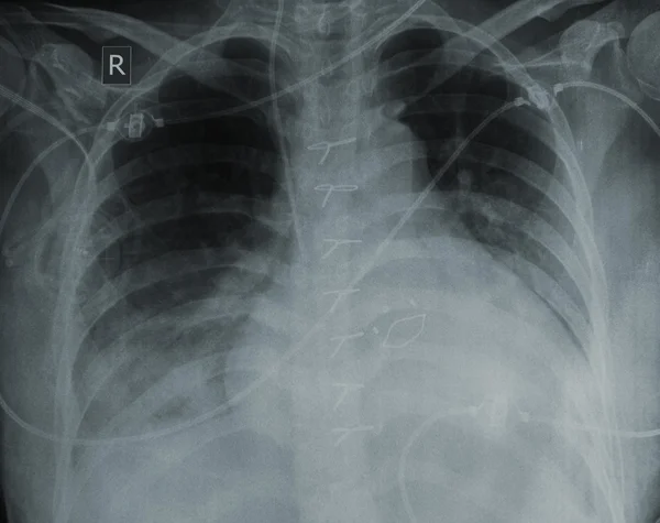 Raggi X di un paziente con malattie cardiache — Foto Stock