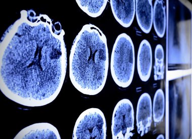 CT x-ray 