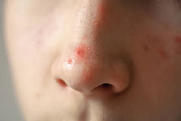 large pimple on the nose close-up, black pores, oily skin, teenage problems, pimples on the face, problem skin care, cosmetology