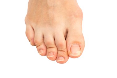 portre ile kırık bir insan ayak ve ayak parmağı peeling üzerinde en büyük toe nail