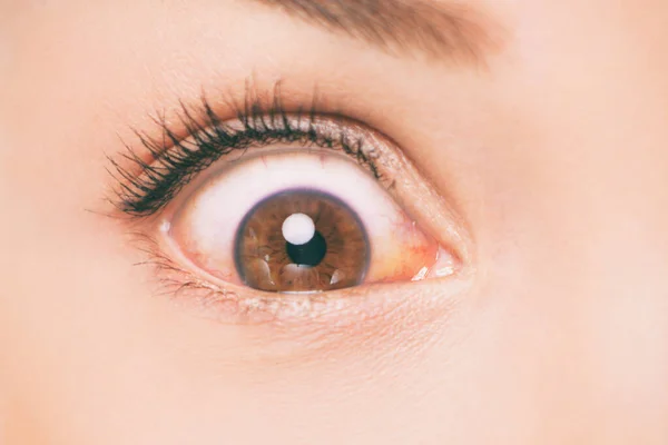 Conjunctivitis rode ogen infectie vrouw in shock allergie in de ogen pinkeye medische gezondheidsprobleem verstoord. Close-up van Aziatische persoon — Stockfoto