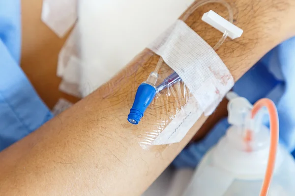 IV игла на руке пациента для инъекции лекарств — стоковое фото