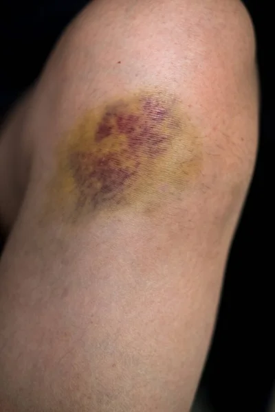 Blutergüsse Knie Blutgefäße Unter Der Haut Gebrochen — Stockfoto