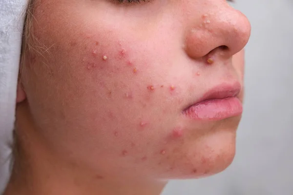 Acne. Teenage girl with the pimples on her face. Close-up. Problematic skin in adolescents.