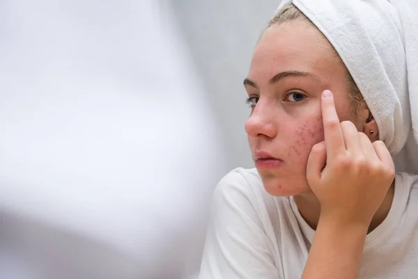 Ein Teenager mit einem weißen Handtuch auf dem Kopf blickt ihr Gesicht mit Problemhaut im Spiegel an Stockbild
