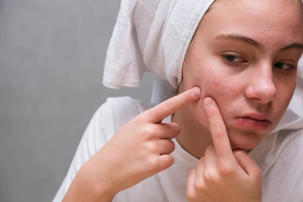 Causes And Effective Treatment For Acne Purging— Stock Photo