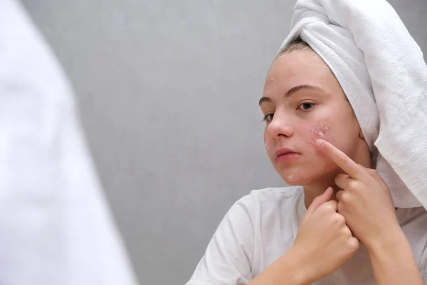 Acne Uma Adolescente Aplicando Medicação Para Acne Rosto Frente Espelho — Fotografia de Stock