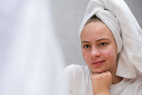 Acne Uma Adolescente Torceu Rosto Que Ela Não Gosta Por — Fotografia de Stock