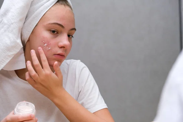 Teenager-Mädchen. Akne. Pflege für Problemhaut Stockbild