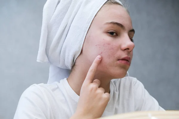 Ein Teenager mit einem weißen Handtuch auf dem Kopf blickt ihr Gesicht mit Problemhaut im Spiegel an Stockfoto