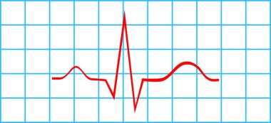 Elektrokardiyogram üzerine normal Atriyal ve Ventriküler depolarizasyon