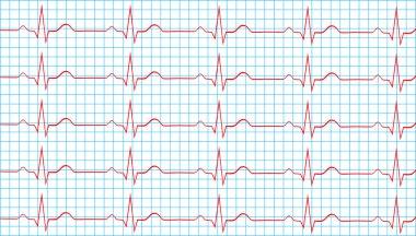 kalp normal sinüs ritmi Elektrokardiyogram kayıt üzerinde