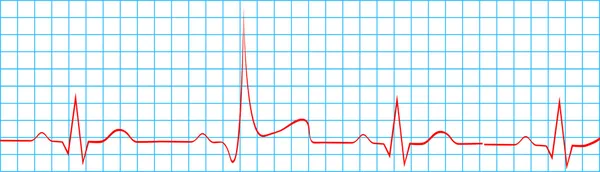 Heart Attack Stroke On Electrocardiogram Record — Stock Vector