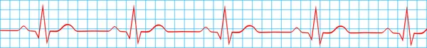 Rythme sinusal normal du cœur sur enregistrement d'électrocardiogramme — Image vectorielle