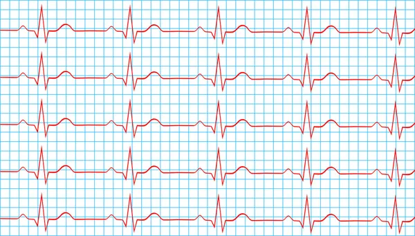 Ritmo sinusal normal del corazón en el registro del electrocardiograma — Vector de stock