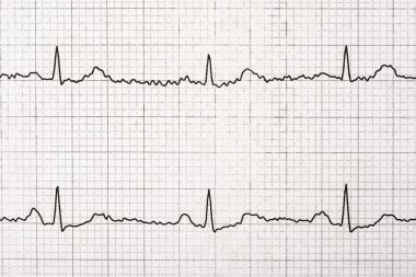 normal Elektrokardiyogram kaydı
