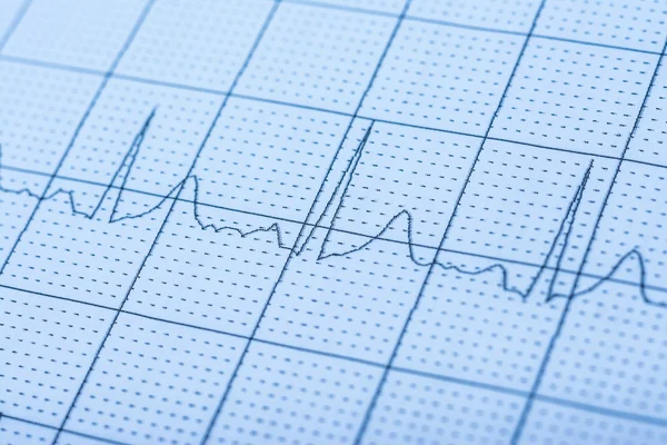 Registro normal del electrocardiograma — Foto de Stock