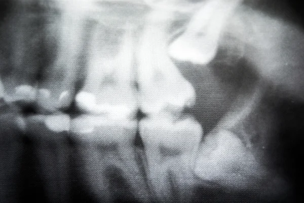 X 射线的疑难的智慧牙 — 图库照片