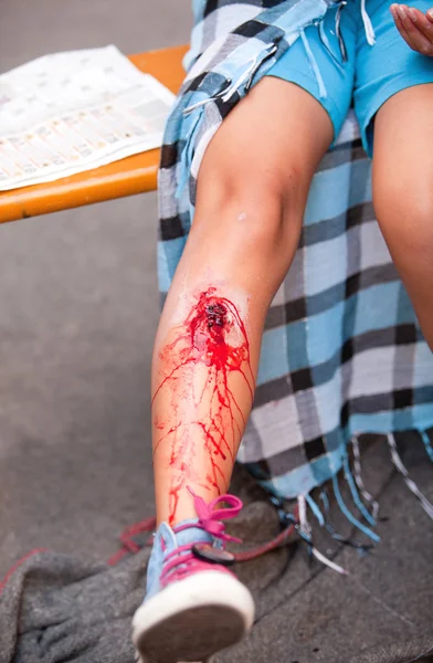 Lesão grave na perna da menina — Fotografia de Stock