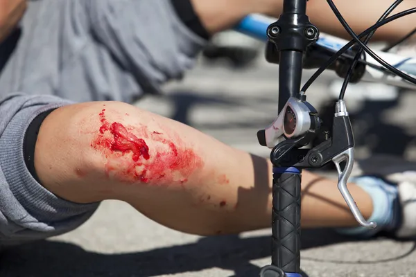 Bike fall injuries — Stockfoto