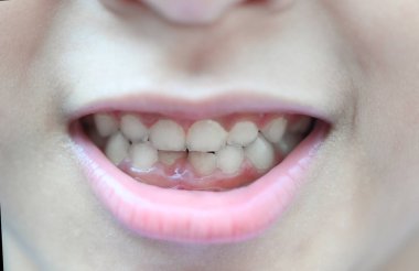 Süt dişi, kapanık diş, diş dökülmesi, kız dişleri gülümseme dudaklar ve süt dişi sağlık sorunları kavramı. 