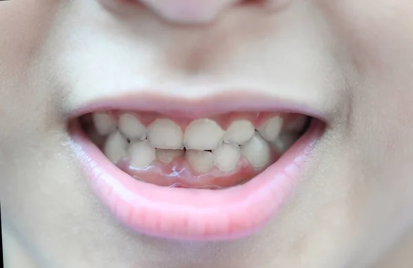 Milk tooth , Closeup baby teeth of tooth loss , the girl child teeth mouth smile open mouth with lips and milk tooth dental health problems concept