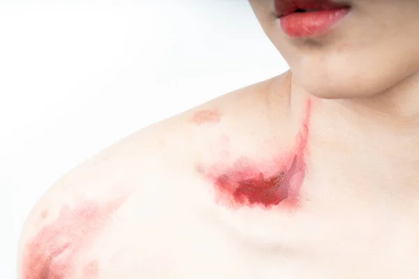 Blood Injured Human Skin — Stock Photo, Image