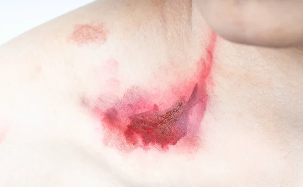 Blut Von Verletzter Menschlicher Haut — Stockfoto