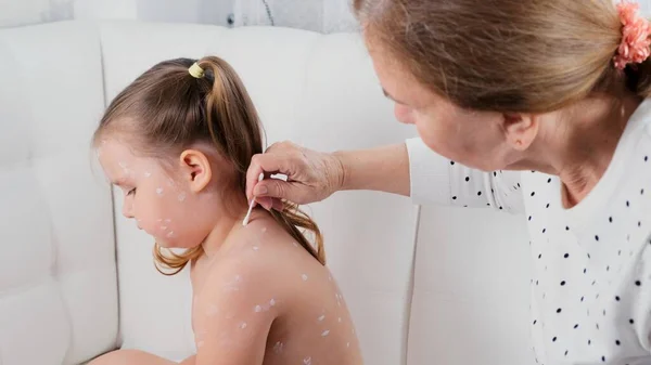 Μητέρα αντιμετωπίζει το εξάνθημα στο σώμα ενός μικρού κοριτσιού 3-4 ετών με αντισηπτική αλοιφή στο σπίτι, τα συμπτώματα και τη θεραπεία της ανεμοβλογιάς ιογενή νόσο. — Φωτογραφία Αρχείου