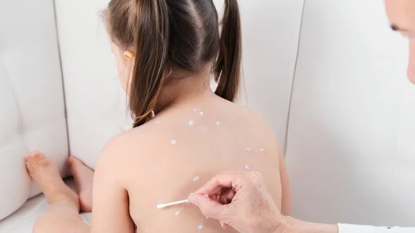 Θηλυκό που αντιμετωπίζεται με εξάνθημα ανεμοβλογιάς στο σώμα των μικρών κοριτσιών με αντισηπτική κρέμα στο σπίτι. Ο αιτιολογικός παράγοντας της ανεμοβλογιάς είναι ο ιός της ανεμευλογιάς-ζωστήρα Varicella Zoster — Φωτογραφία Αρχείου