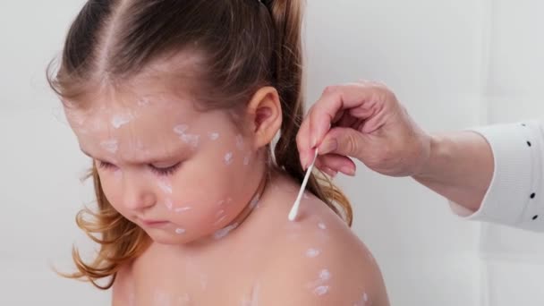 Little girl with chickenpox, antiseptic cream applied to rash. Female hands applying cream on little girl with chicken pox at home — Stock Video