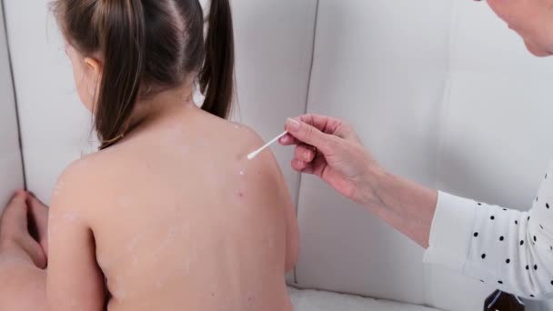 Back girl with chickenpox, antiseptic cream applied to the rash. Rash period. The resulting rash looks like pink spots, which turn into papules, some of which. With skin rashes, enanthema appears on — Stock Video
