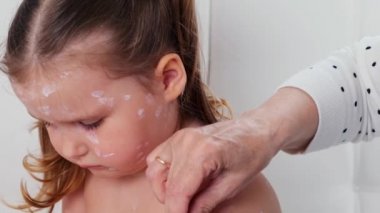 Suçiçeği olan üzgün küçük bir kız, kızarıklığa antiseptik krem sürülmüş. Aceleci dönem. Kurdeşen pembe lekeler gibi görünüyor, bazıları papüle dönüşüyor. Deri döküntüleri, enanthema