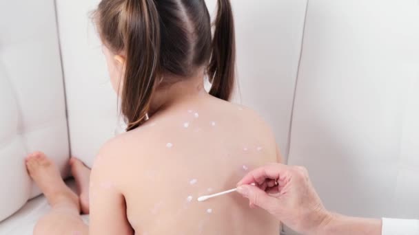 Female being treated with chickenpox rash on little girls body with atiseptic cream at home. The causative agent of chickenpox is the varicella-zoster virus Varicella Zoster — Stock Video