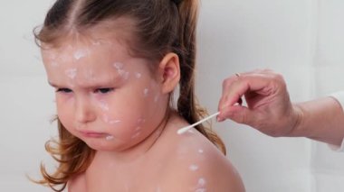 Suçiçeği olan üzgün küçük bir kız, kızarıklığa antiseptik krem sürülmüş. Aceleci dönem. Kurdeşen pembe lekeler gibi görünüyor, bazıları papüle dönüşüyor. Deri döküntüleri, enanthema