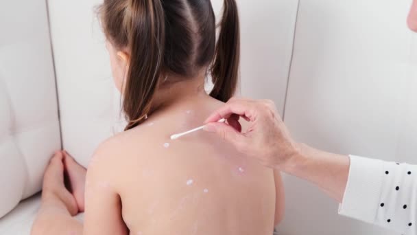 Vrouwelijke handen behandelen huiduitslag van waterpokken op het lichaam van een klein meisje met atiseptische crème thuis. Symptomen, behandeling van waterpokken virale ziekte — Stockvideo