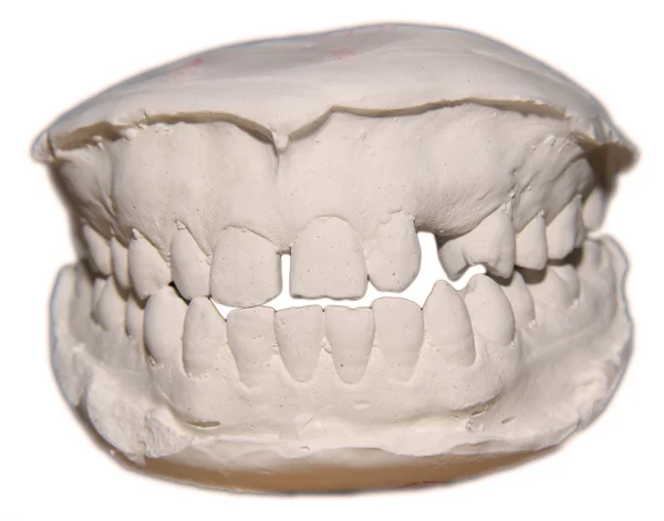 The view of dental cast,front,for orthodontics and education — Stock Photo, Image