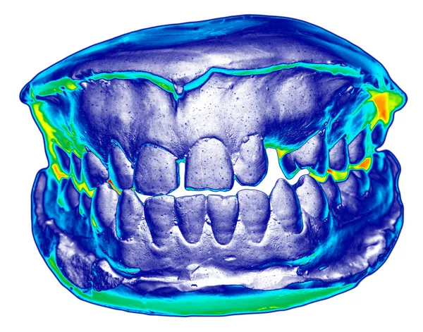 Diş dökme, açık, scansion görünümünü