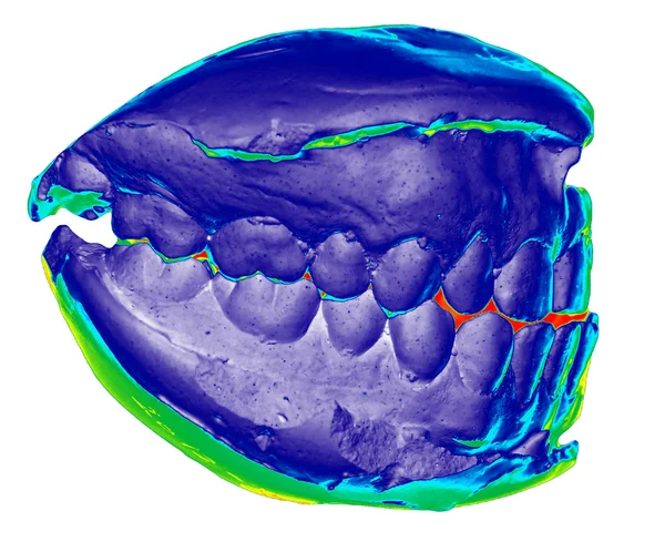 Elenco dental, el lado izquierdo, tono — Foto de Stock