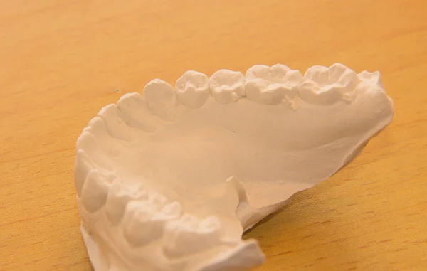 Dental cast,important part of orthodontics — Stock Photo, Image