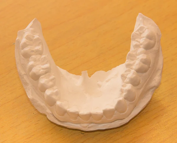 Una parte del yeso dental — Foto de Stock