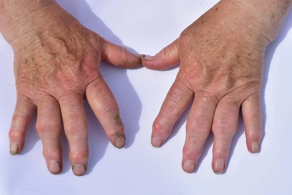 Mani colpite da artrosi — Foto Stock