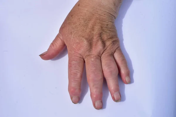 Mano derecha afectada por artrosis en blanco —  Fotos de Stock