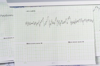 tıbbi bulgular grafiği. Yeşil çizgilerini düzensiz satırları.